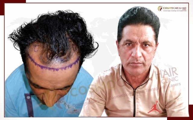 Hair Transplant In Chandigarh