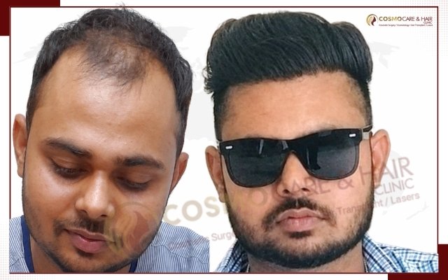 Hair Transplant Clinic In Chandigarh