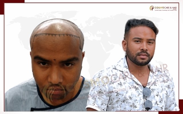 Best Hair Transplant In Chandigarh