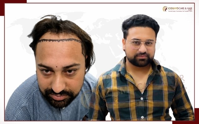 Hair Transplant Doctor In Chandigarh
