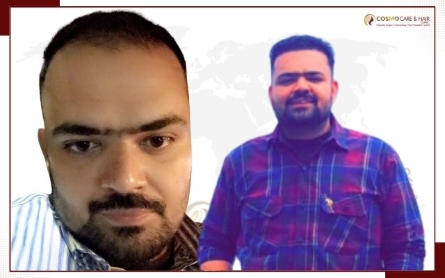 Hair Transplant Clinic In Chandigarh