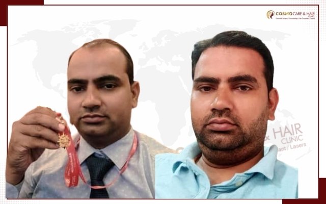 Hair Transplant Clinic In Chandigarh