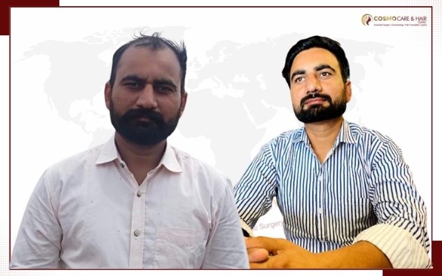 Hair Transplant Clinic In Chandigarh