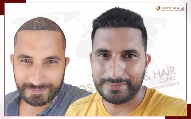 Hair Transplant Doctor In Chandigarh
