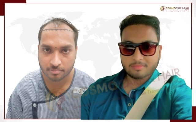 Hair Transplant Clinic In Chandigarh