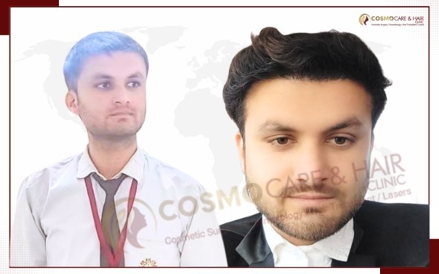 Hair Transplant Doctor In Chandigarh