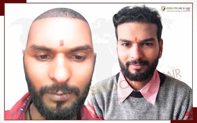 Hair Transplant Clinic In Chandigarh