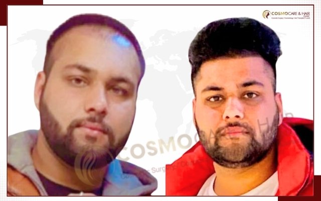 Hair Transplant In Chandigarh