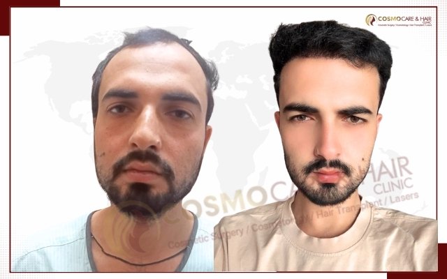 Best Hair Transplant In Chandigarh