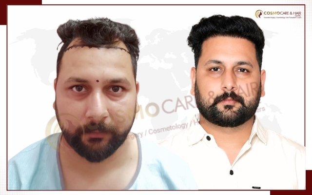 Hair Transplant In Chandigarh