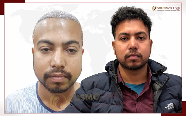 Best Hair Transplant Clinic in Chandigarh