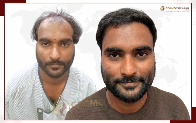 Best Hair Transplant Clinic in Chandigarh
