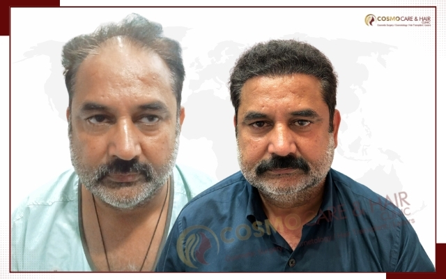 Best Hair Transplant Clinic in Chandigarh