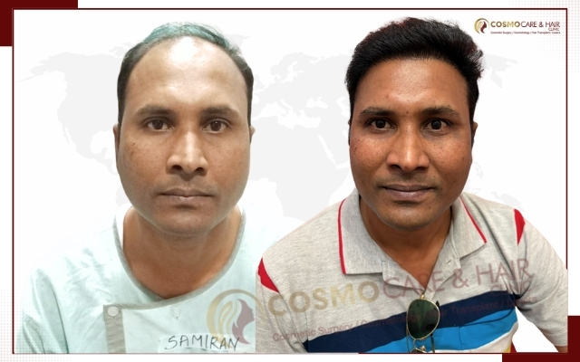 Best Hair Transplant in Chandigarh