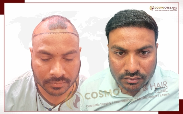 Best Hair Transplant in Chandigarh