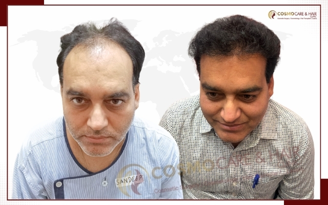Best Hair Transplant in Chandigarh