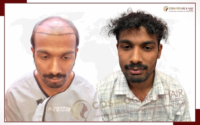 Best Hair Transplant in Chandigarh