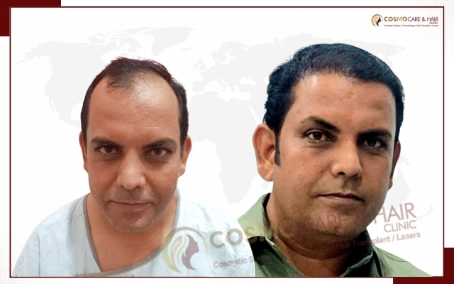 Best Hair Transplant in Chandigarh