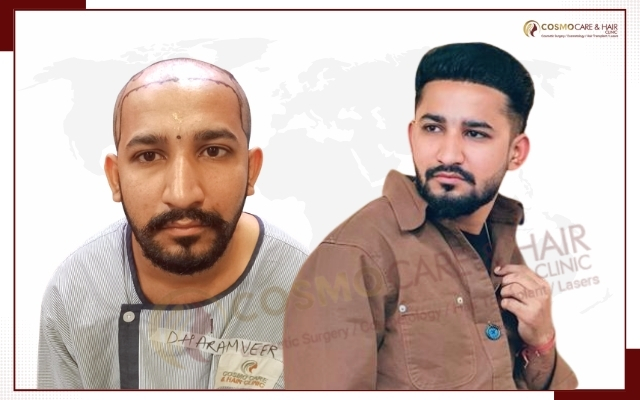 Best Hair Transplant in Chandigarh