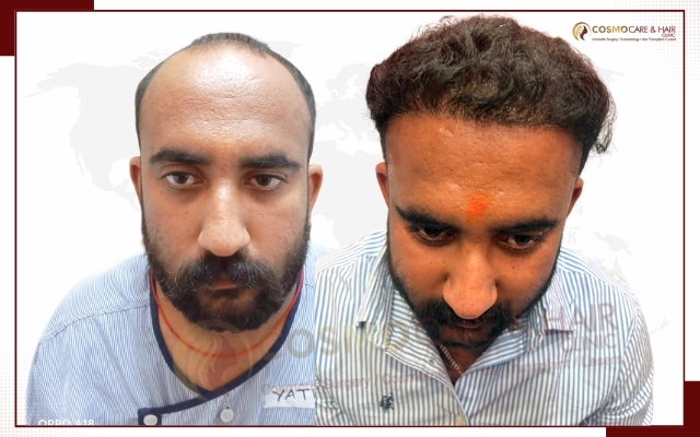 Best Hair Transplant in Chandigarh