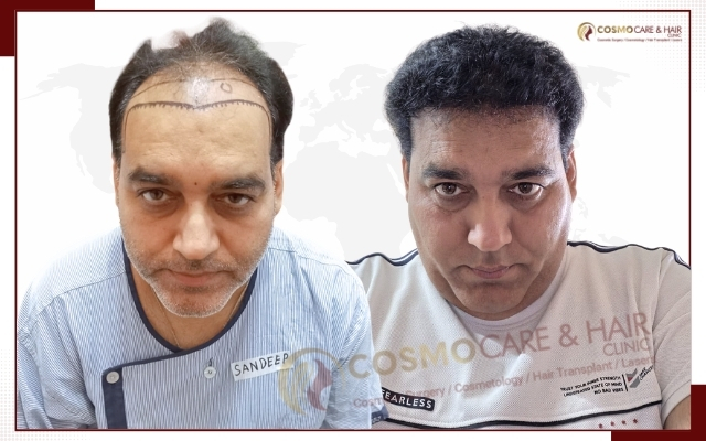 Best Hair Transplant in Chandigarh