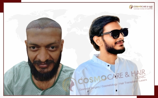 Best Hair Transplant in Chandigarh