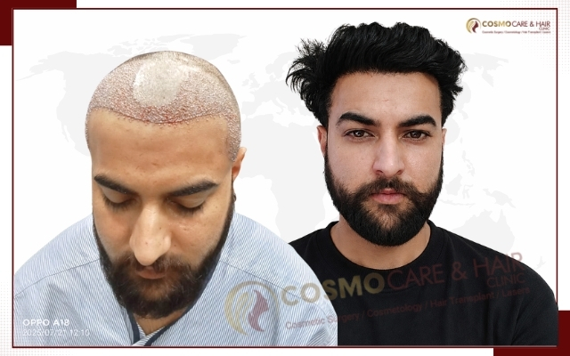 Best Hair Transplant in Chandigarh