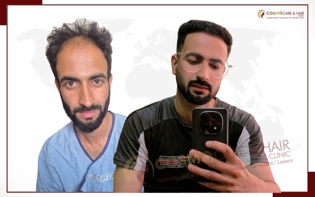 Best Hair Transplant in Chandigarh