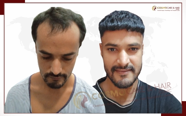 Best Hair Transplant in Chandigarh