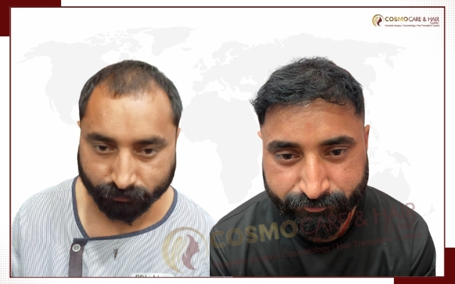 Best Hair Transplant in Chandigarh