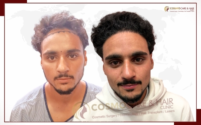 Hair Transplant Clinic in Chandigarh