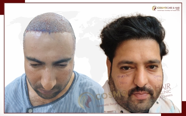 Hair Transplant Clinic in Chandigarh
