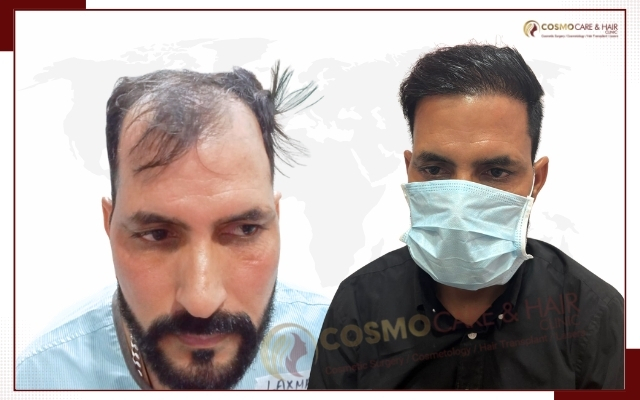 Hair Transplant Clinic in Chandigarh