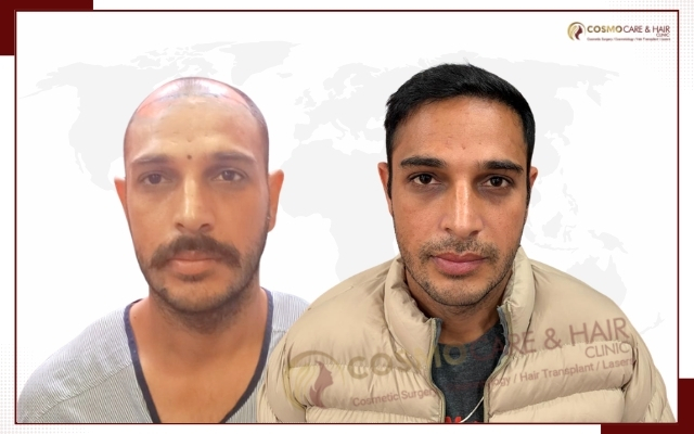 Hair Transplant Clinic in Chandigarh (16)