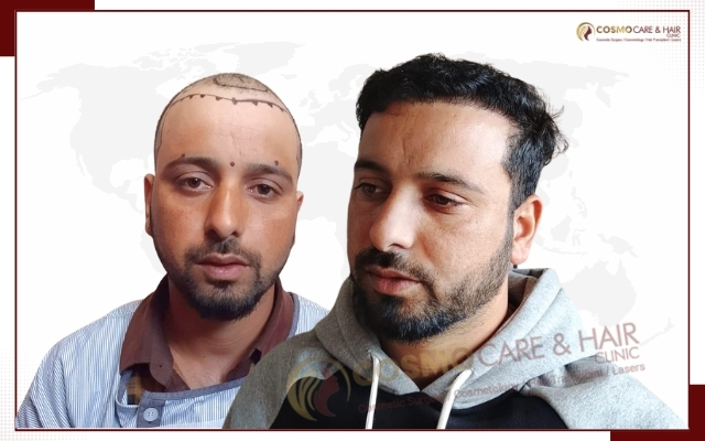 Hair Transplant Clinic in Chandigarh (17)