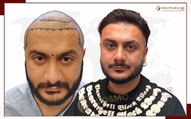 Hair Transplant Clinic in Chandigarh (18)