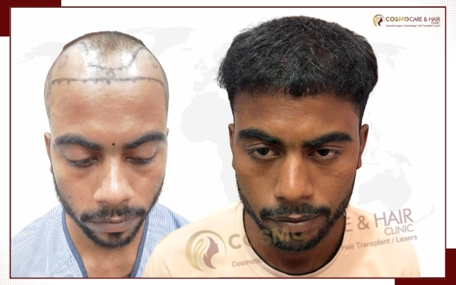 Hair Transplant Clinic in Chandigarh (19)