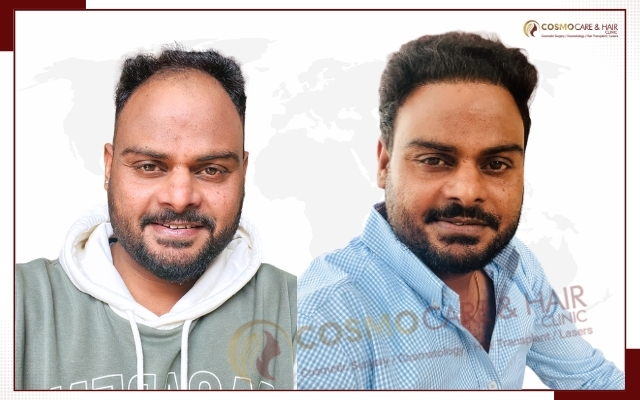 Hair Transplant Clinic in Chandigarh