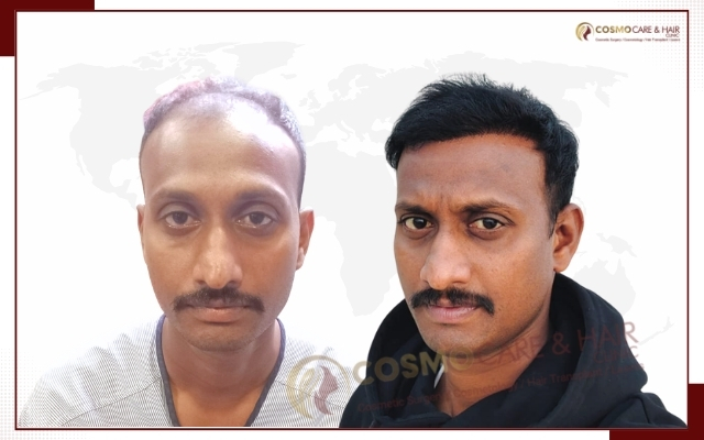 Hair Transplant Clinic in Chandigarh (20)