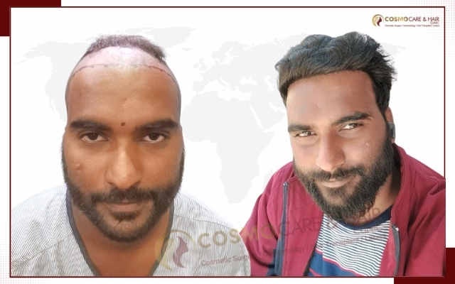 Hair Transplant Clinic in Chandigarh (21)