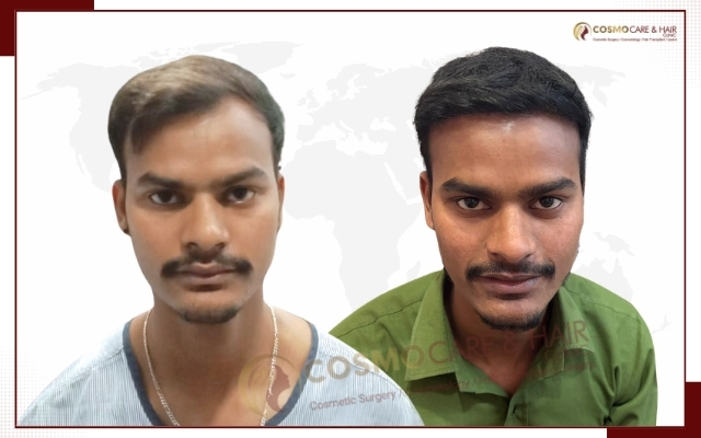Hair Transplant Clinic in Chandigarh (22)