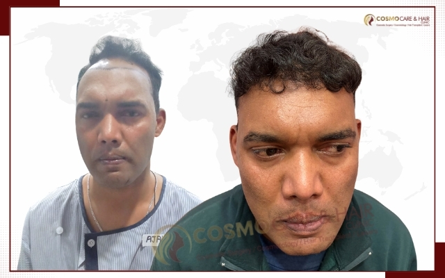 Hair Transplant Clinic in Chandigarh (23)