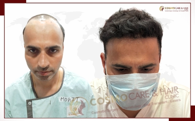 Hair Transplant Clinic in Chandigarh