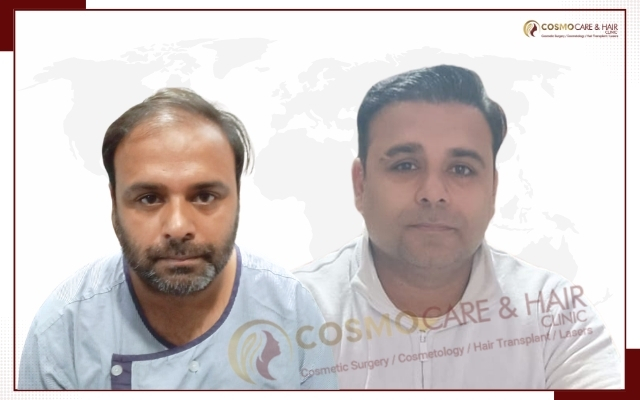 Hair Transplant Clinic in Chandigarh