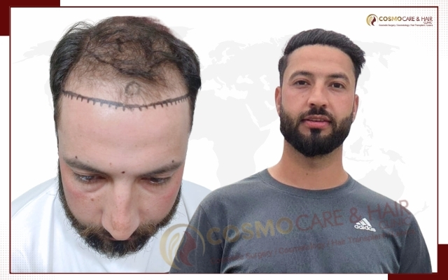 Hair Transplant Clinic in Chandigarh