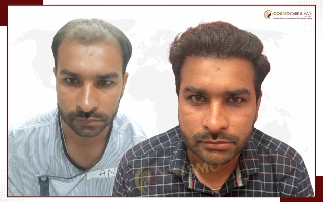 Hair Transplant Clinic in Chandigarh