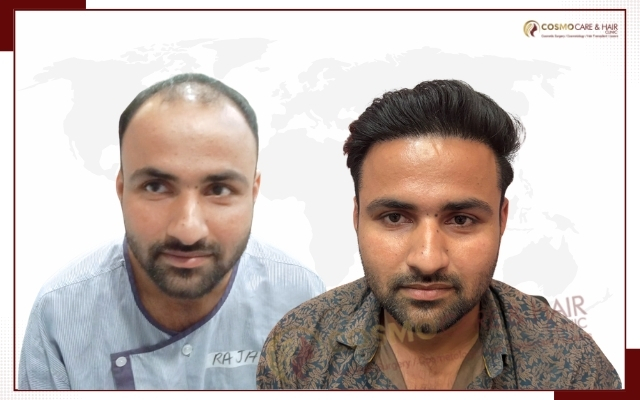 Hair Transplant Clinic in Chandigarh