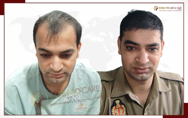 Hair Transplant Clinic in Chandigarh