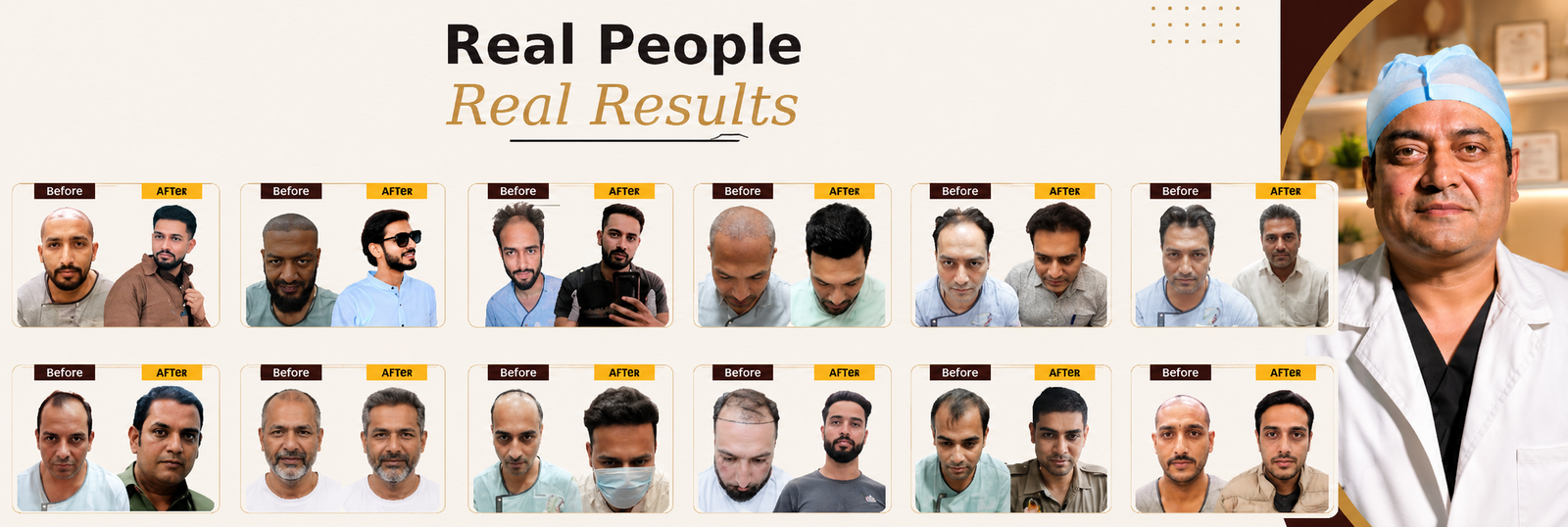 Hair Transplant Clinic in Chandigarh Results
