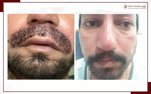 Moustache Hair Transplant